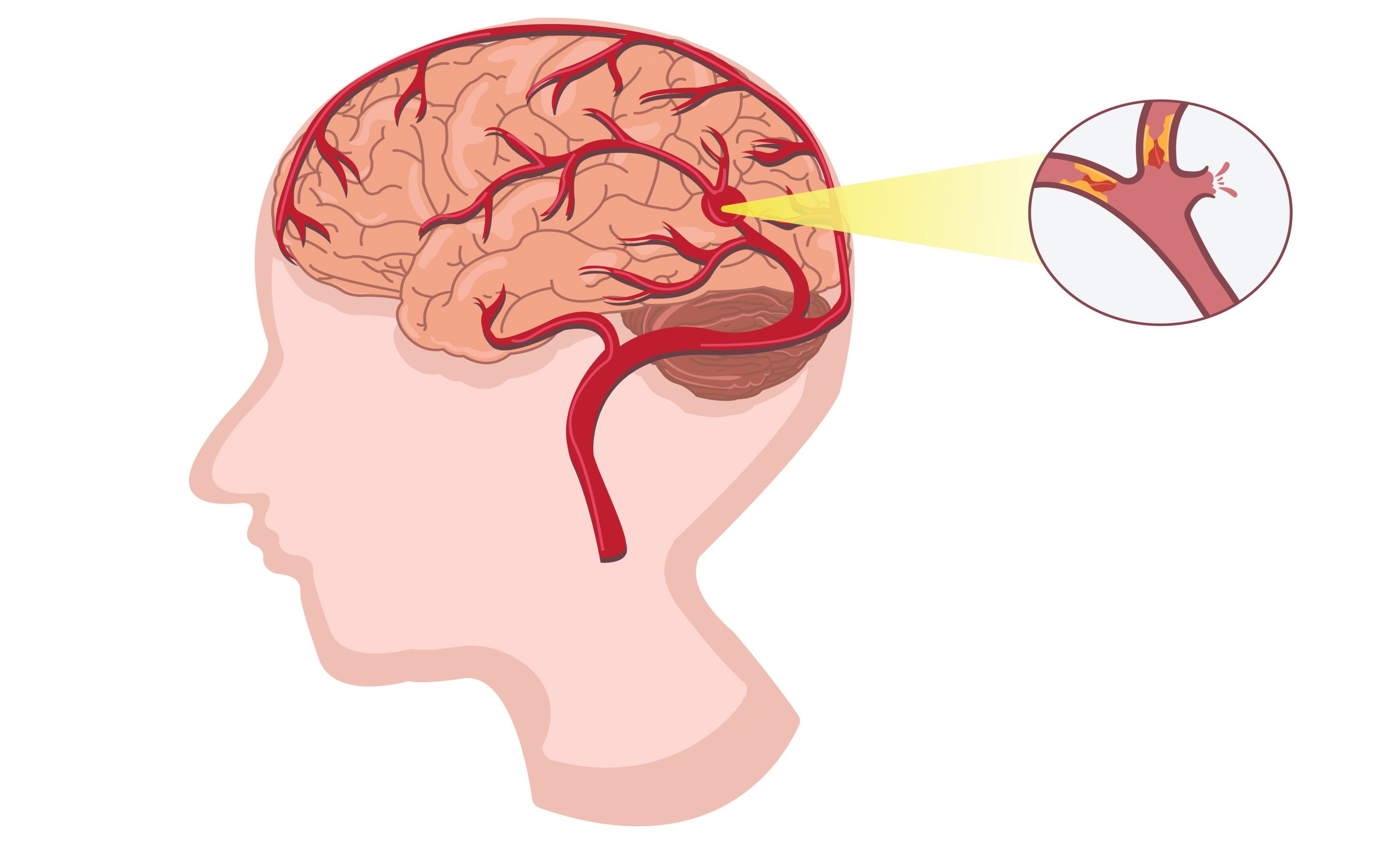 ABCD2 Score Calculator: A Crucial Tool for Predicting Stroke Risk